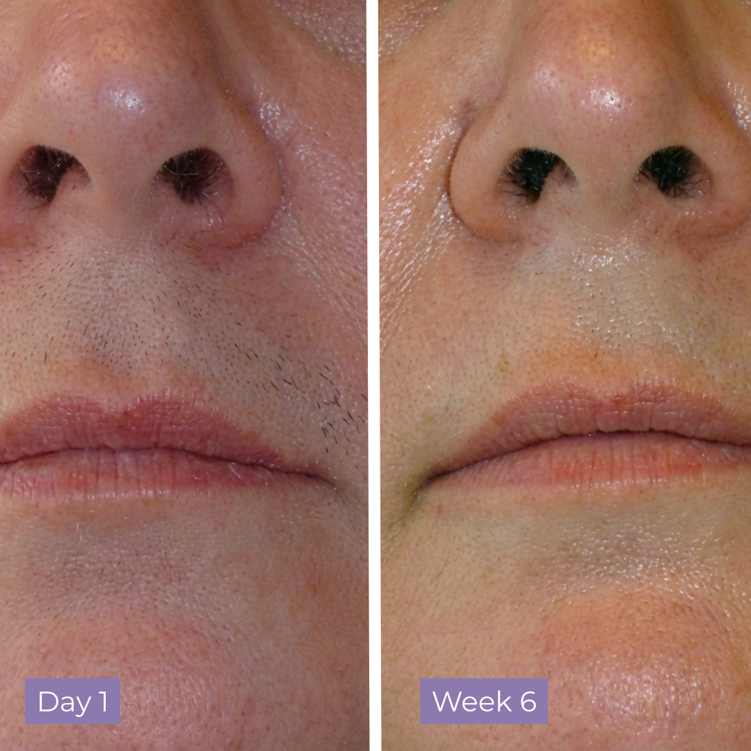 Kelle Anti-Hair Skin Serum