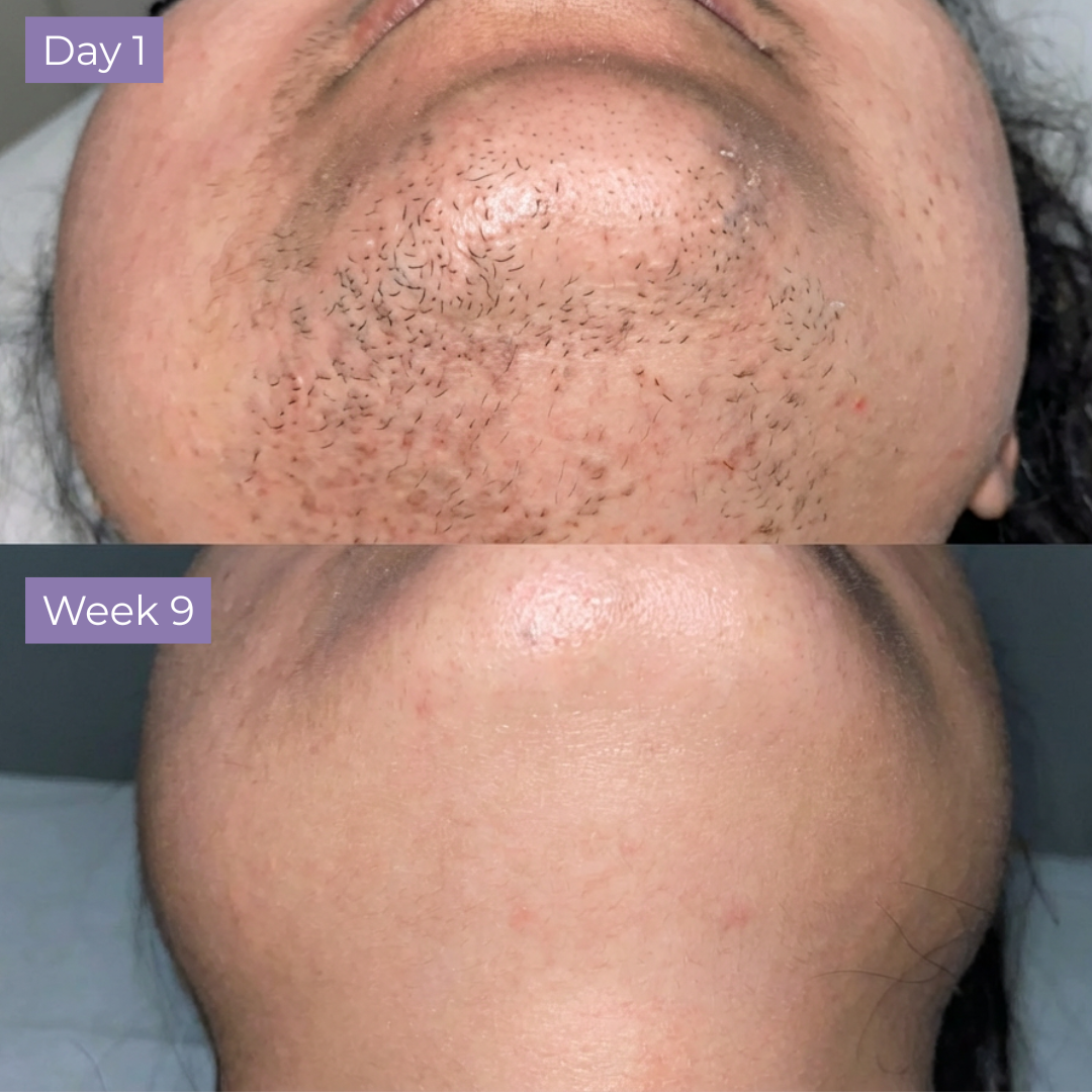 Kelle Anti-Hair Skin Serum