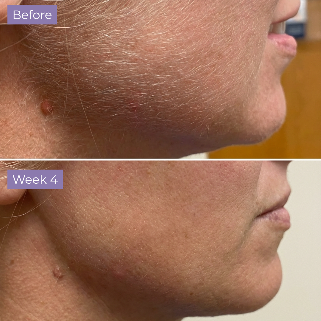 Kelle Anti-Hair Skin Serum