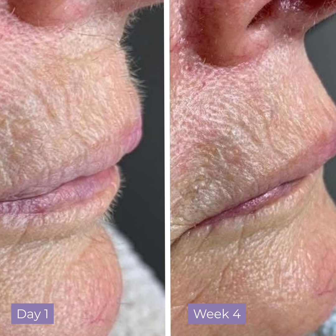 Kelle Anti-Hair Skin Serum